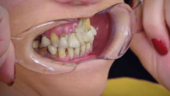 Žena si deset let lepila zuby vteřinovým lepidlem