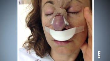Lékaři zachránili ženě nos poté, co používala mast na rakovinu