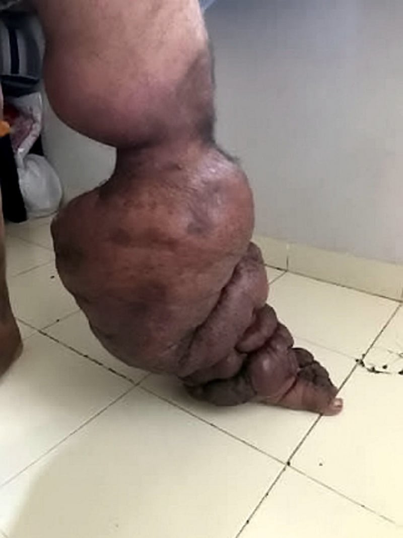 Muž z Indie má syndrom sloní nohy - Obrázek 4