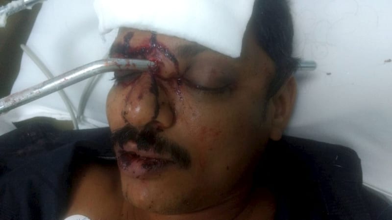 Muž skončil s kovovou tyčí zaraženou v obličeji 1