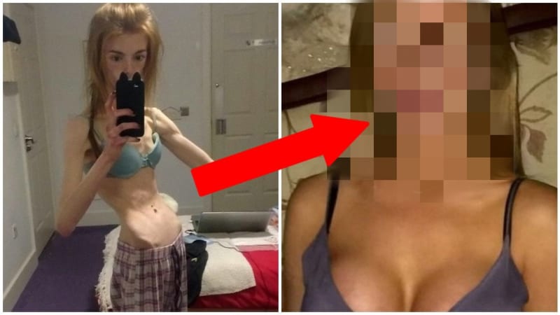 Dívka porazila anorexii čokoládou 11