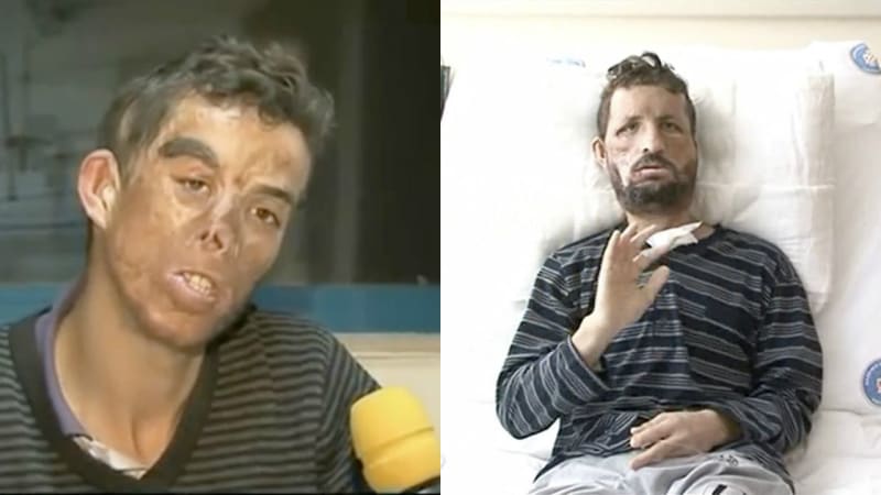 Ugur Acar byl velmi vážně popálený. Tvář mu transplantovali v roce 2012.