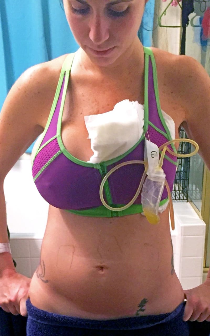 Žena přišla o prso kvůli piercingu - Obrázek 2