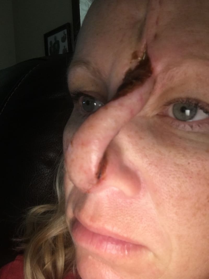 Žena s dírou v nose po rakovině kůže 11
