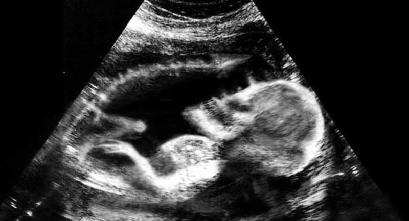 Ultrazvuky miminek, které nevypadají moc jako miminka. Báli byste se jich? - Obrázek 1