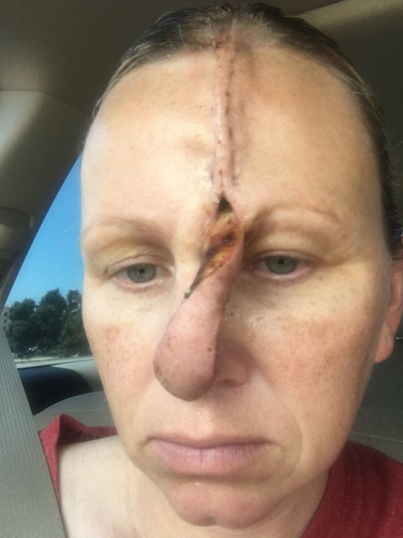 Žena s dírou v nose po rakovině kůže 10