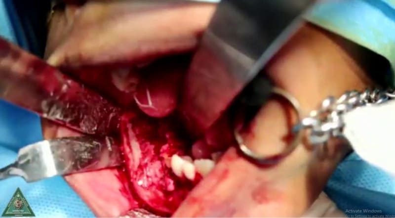 Lékaři vyoperovali chlapci z úst obří množství zubů 3