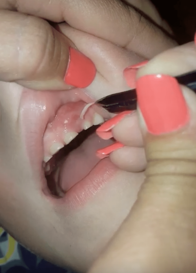 Žena vytáhla synovi z úst 30 ukousaných nehtů.
