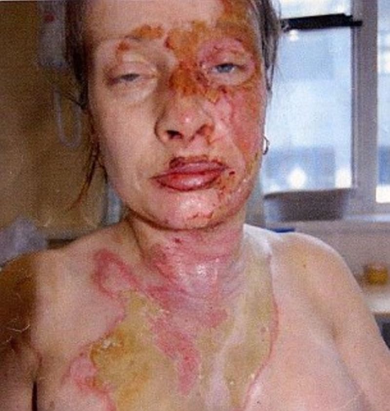 Žena popálená vodou z varné konvice - Obrázek 3