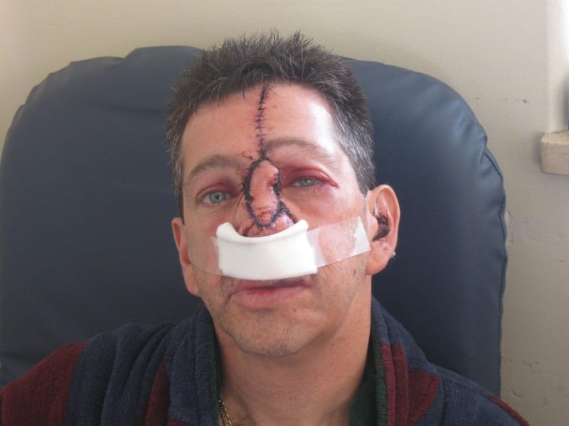 Drsné fotky - rakovina muži vzala oko, nos, i levou tvář 2