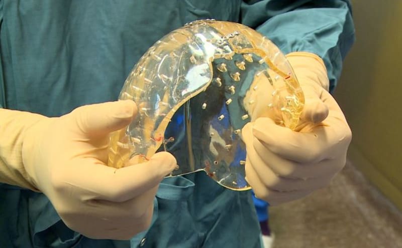 V univerzitním lékařském ústavu v Utrechtu v Nizozemsku lékaři transplantovali 22-leté pacientce vytisknutý 3D model lidské lebky. Jde o první uskutečněnou operaci na světě.