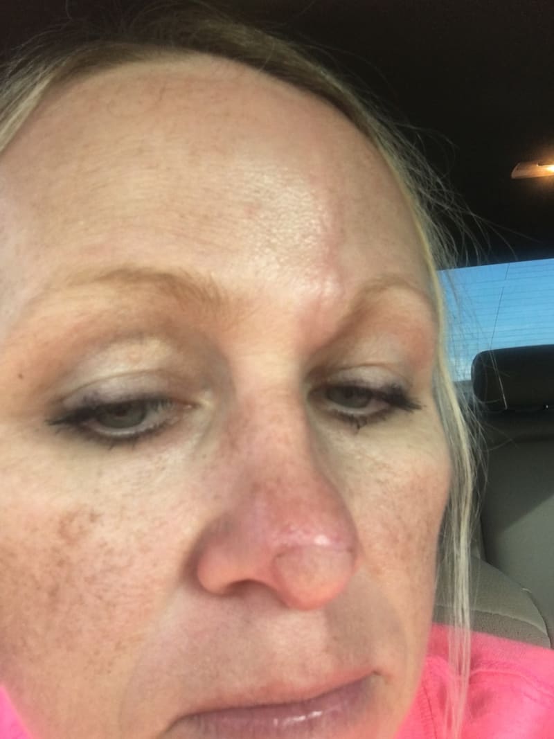Žena s dírou v nose po rakovině kůže 6