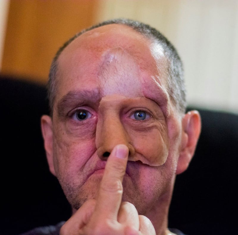 Drsné fotky - rakovina muži vzala oko, nos, i levou tvář 5