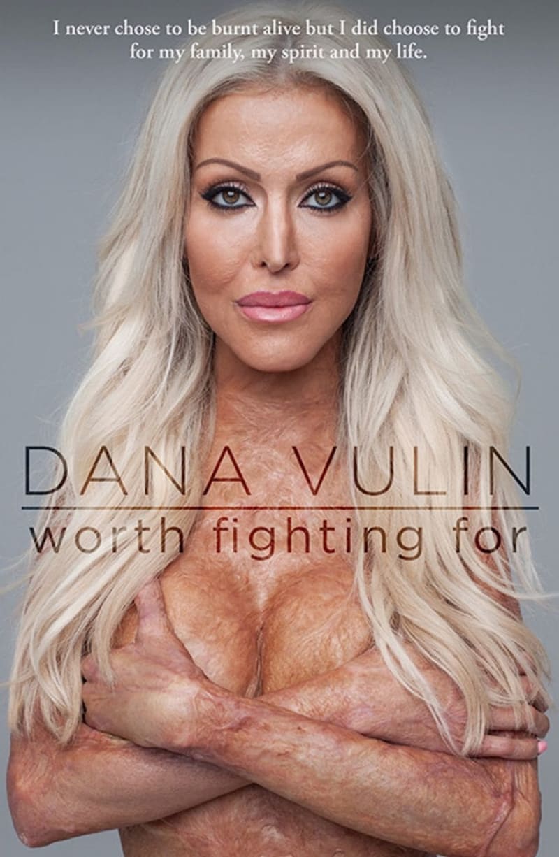 Dana Vulin - oběť děsivého útoku ohněm 9