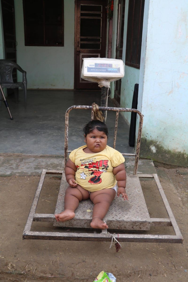 Obézní holčička trpí vzácnou nemocí 4