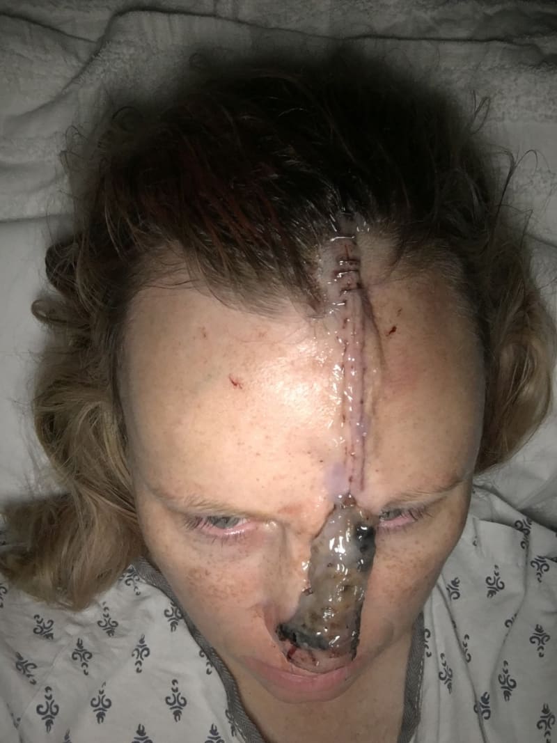 Žena s dírou v nose po rakovině kůže 7