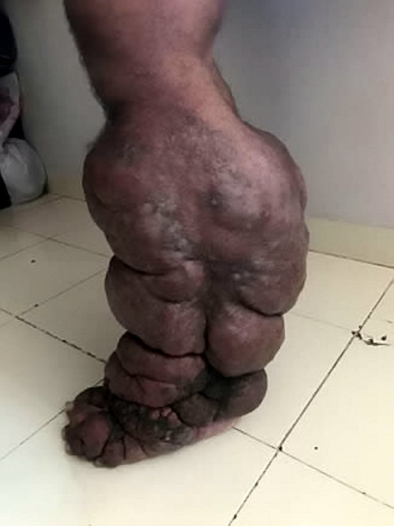 Muž z Indie má syndrom sloní nohy - Obrázek 3