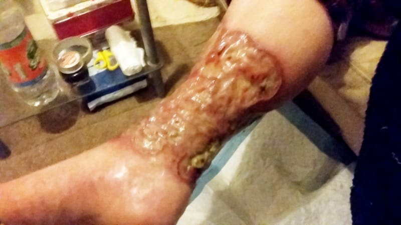 Ženě museli amputovat nohu poté, co se řízla při holení 3