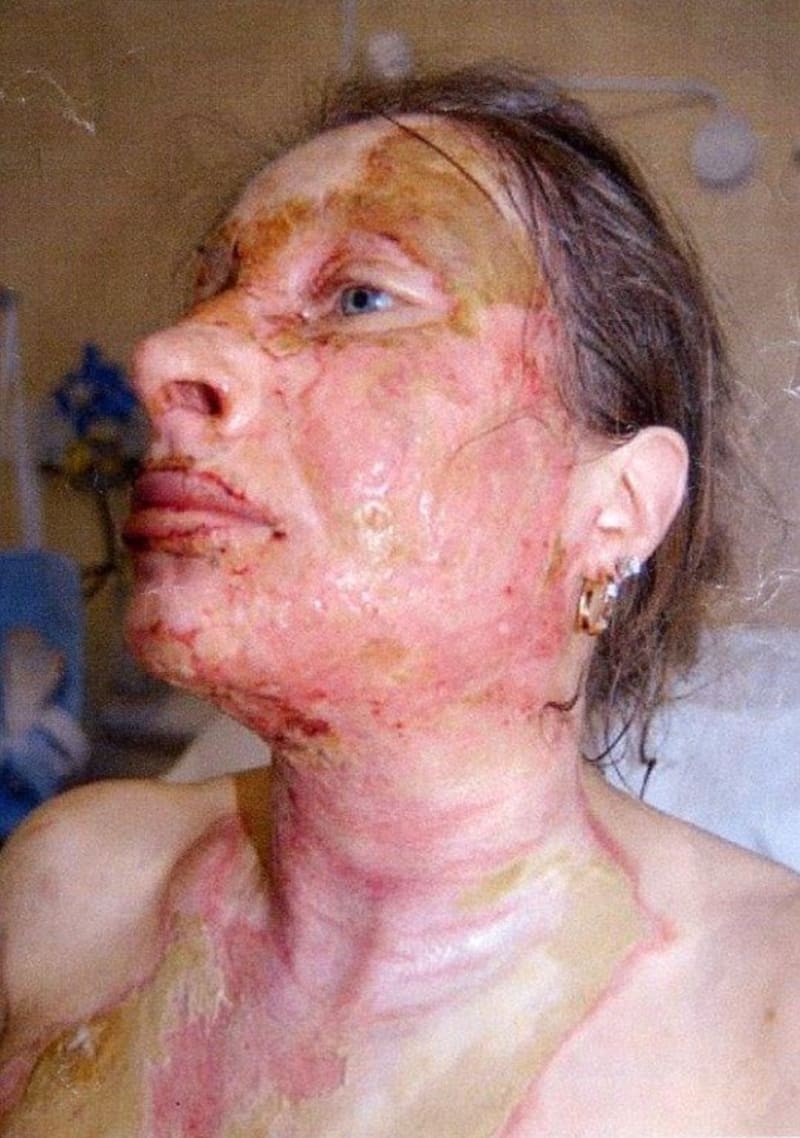 Žena popálená vodou z varné konvice - Obrázek 4