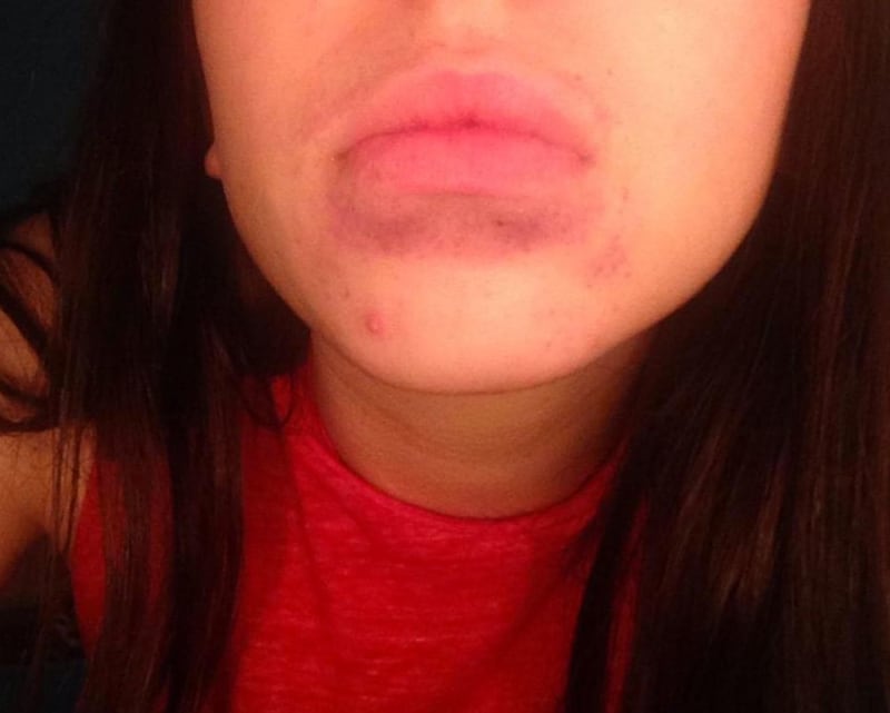 Následky Kylie Jenner lip challenge - Obrázek 3