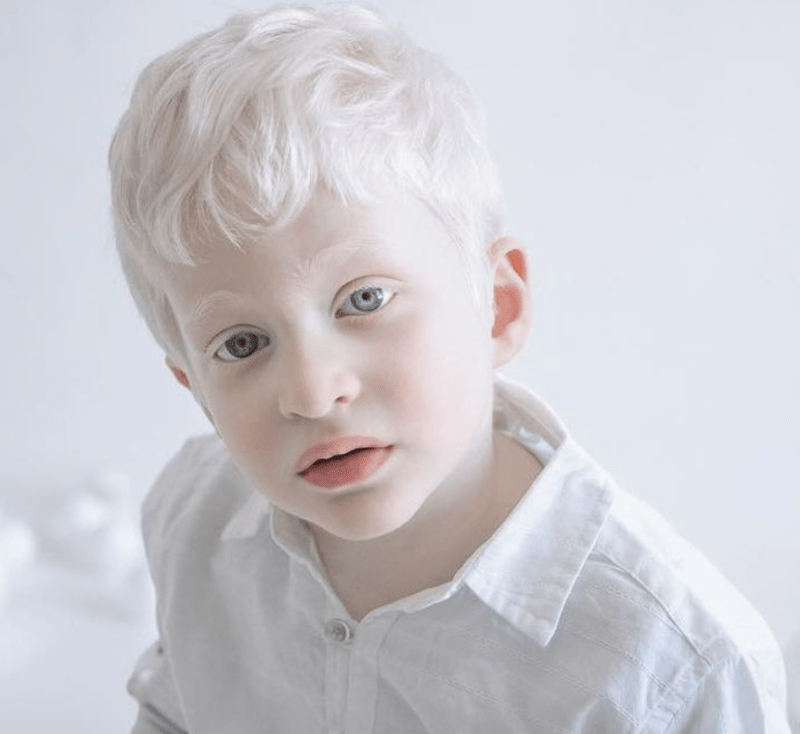 Krása lidí s albinismem 15