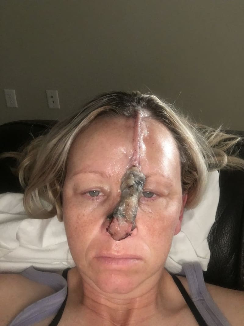 Žena s dírou v nose po rakovině kůže 8