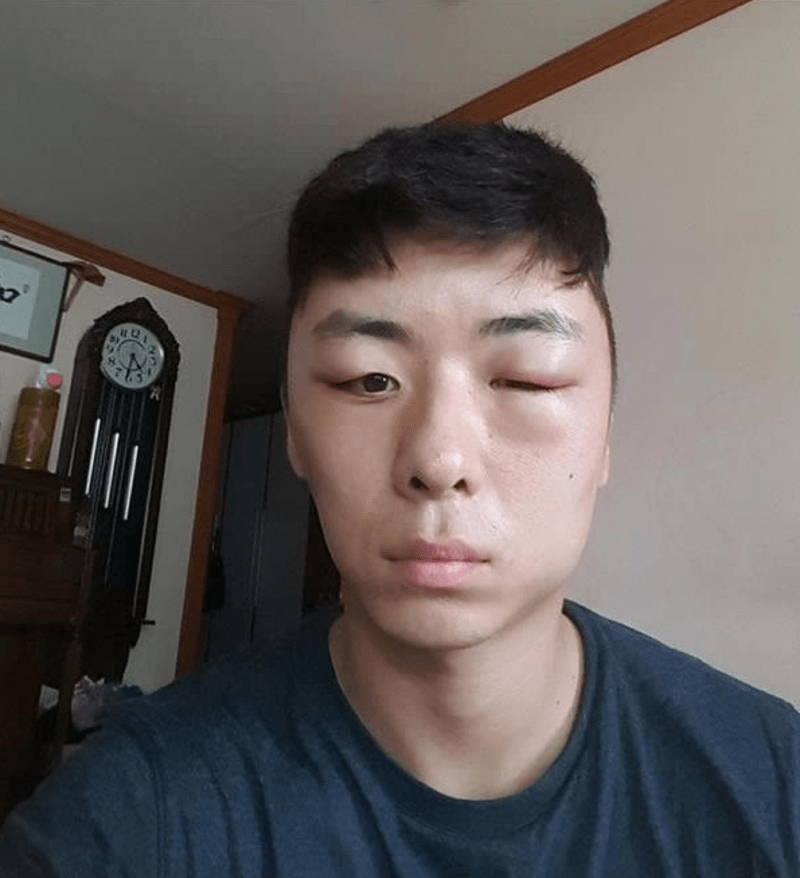 Korejec dostal alergickou reakci na barvu na vlasy - Obrázek 7