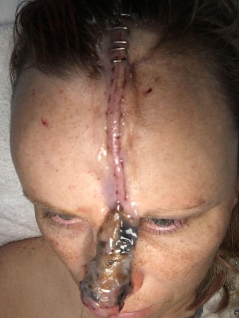 Žena s dírou v nose po rakovině kůže 2