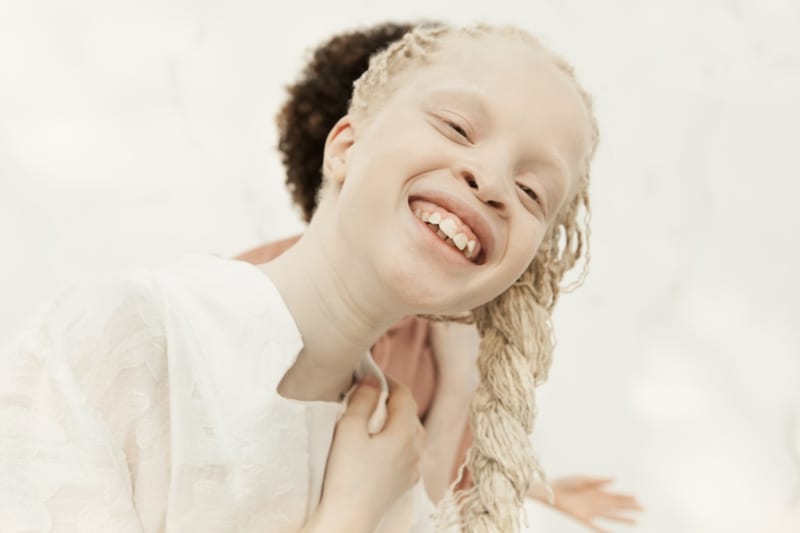 Dvojčata trpící albinismem