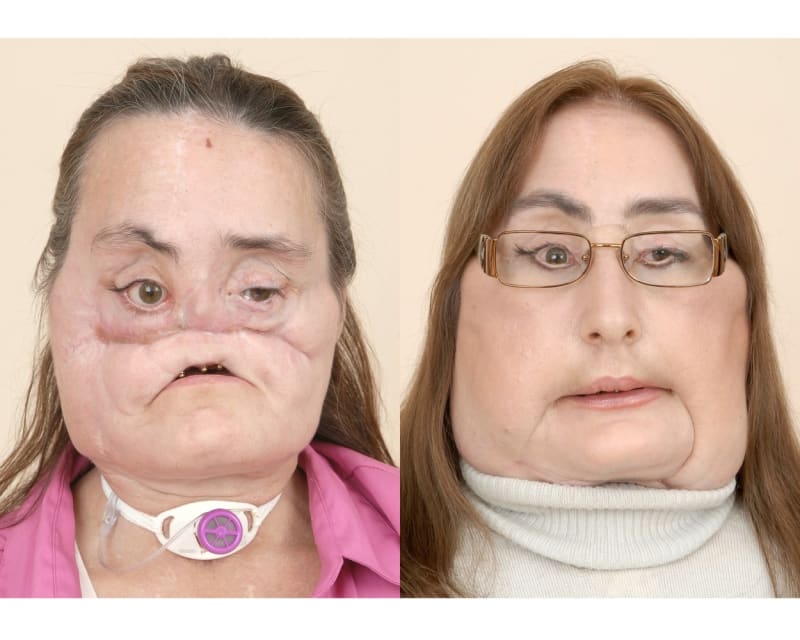Přítel Connie Culp ji střelil do tváře. Obličej jí zachránila transplantace v roce 2008.