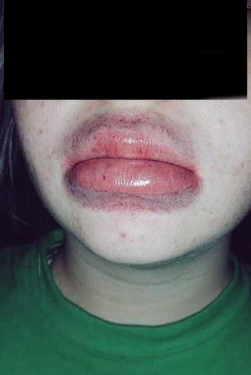 Následky Kylie Jenner lip challenge - Obrázek 7