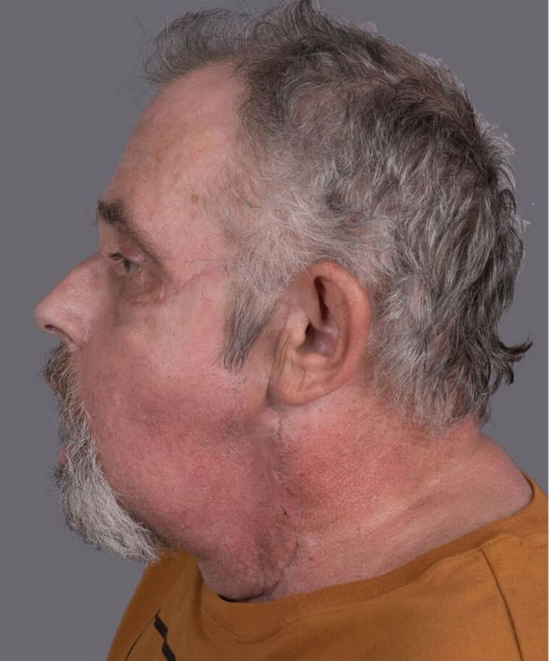 Nejstarší muž s transplantací obličeje 4