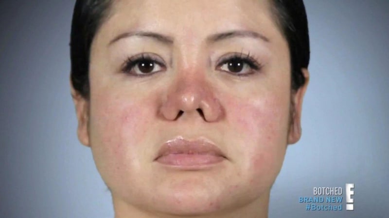 Žena se po liposukci probudila i s plastikou nosu 2