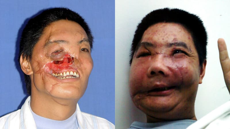 Li Guoxing byl napadený medvědem a prodělal částečnou transplantaci tváře. Na následky komplikací ale nakonec zemřel.