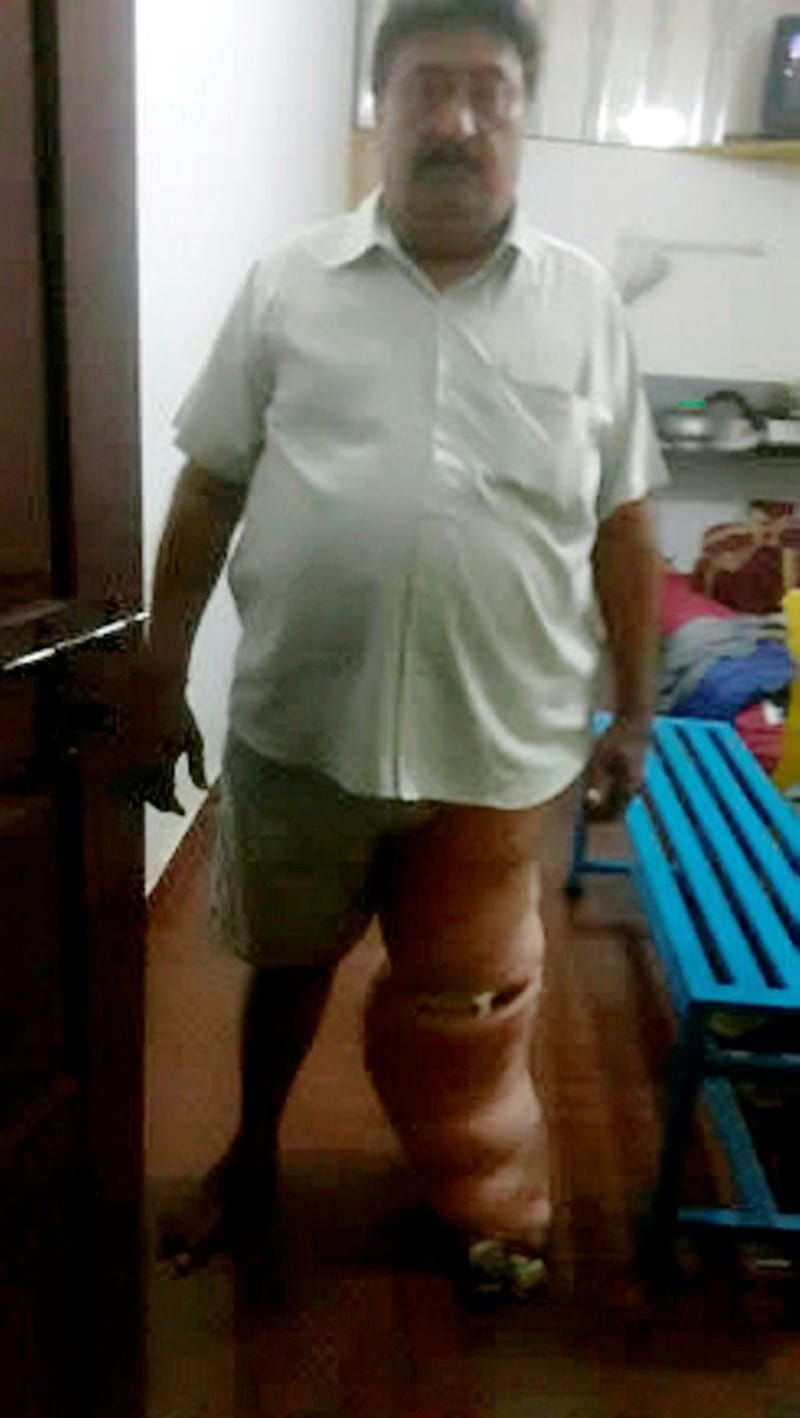Muž z Indie má syndrom sloní nohy - Obrázek 1