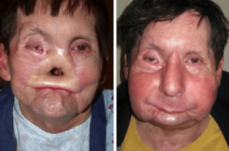James Maki si zranil obličej o elektrickou kolej v metru. Prodělal transplantaci téměř celého obličeje.