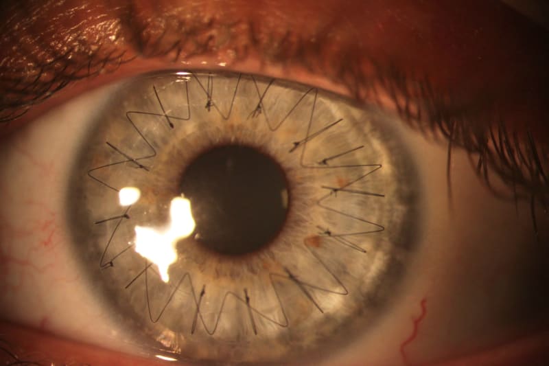 Oko po transplantaci rohovky