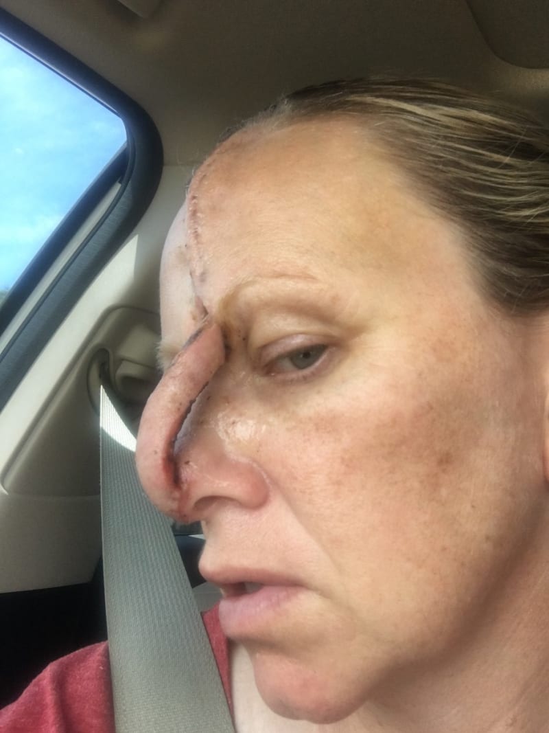 Žena s dírou v nose po rakovině kůže 9