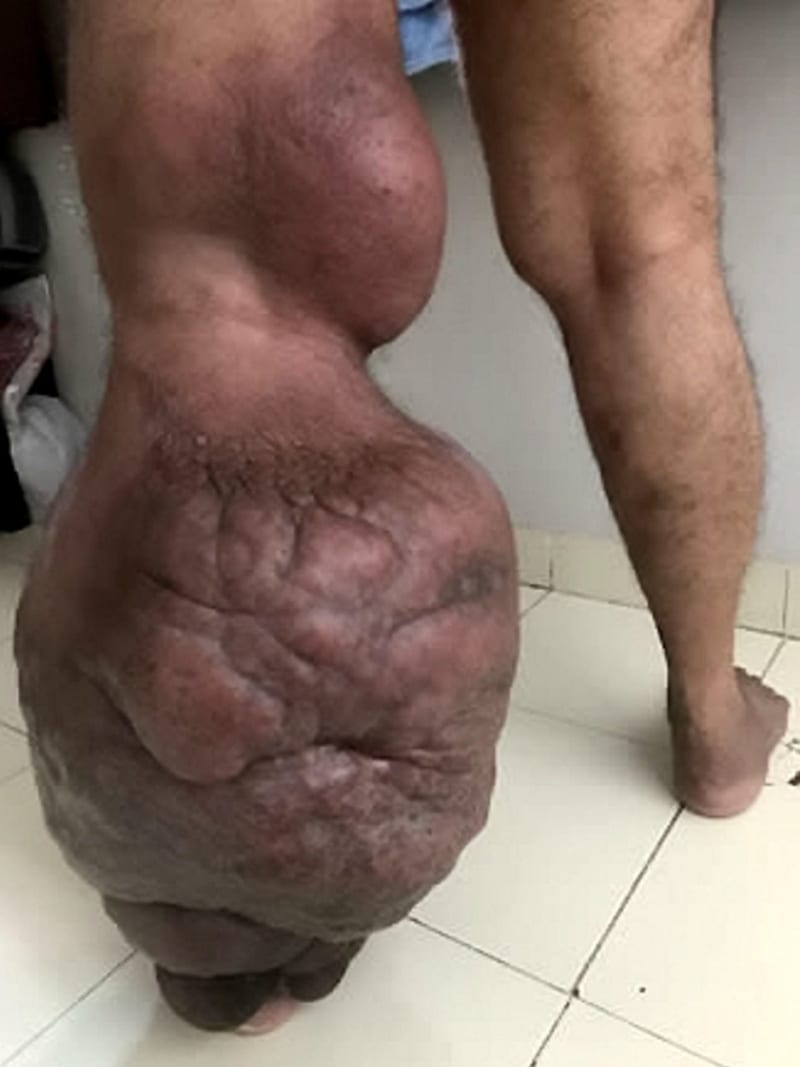 Muž z Indie má syndrom sloní nohy - Obrázek 2
