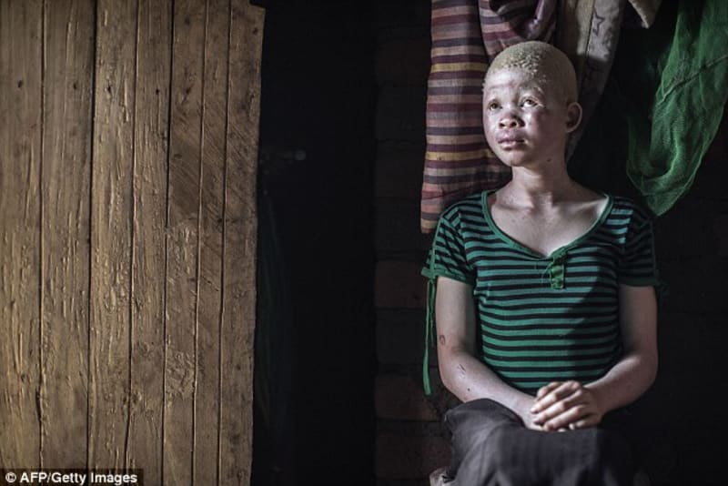 Smutný osud albínů