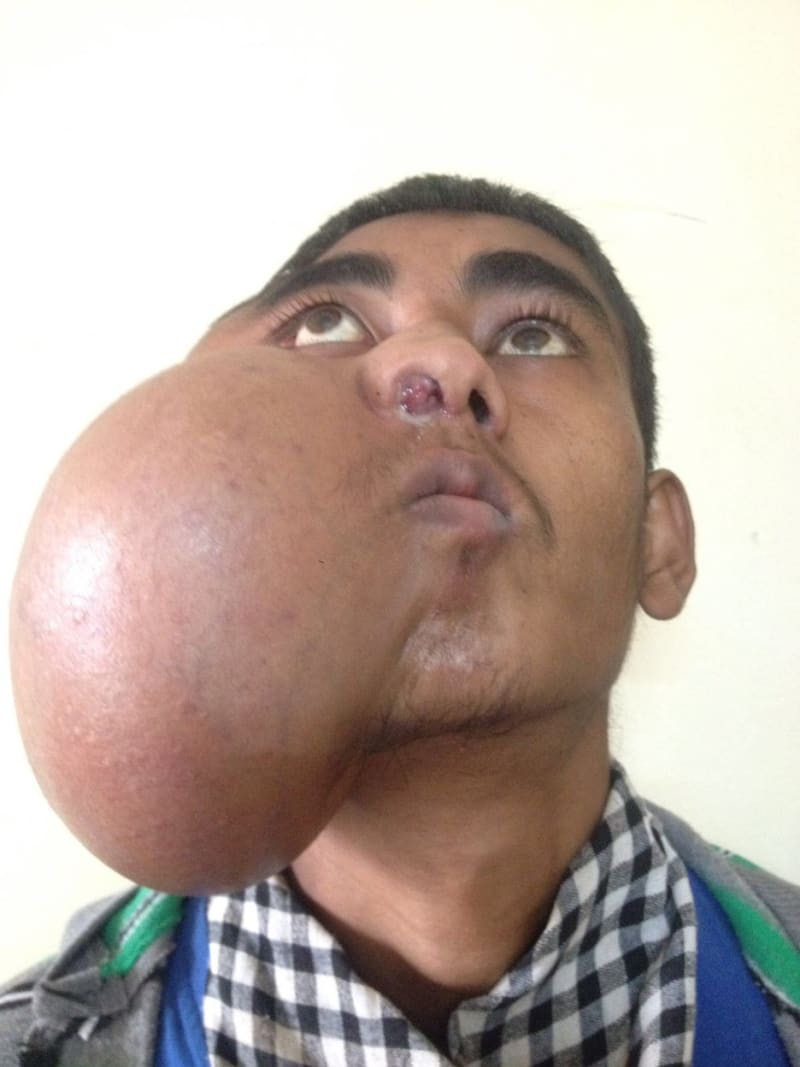 Kluk z Indie Mangat Ram měl na obličeji obrovský nádor.