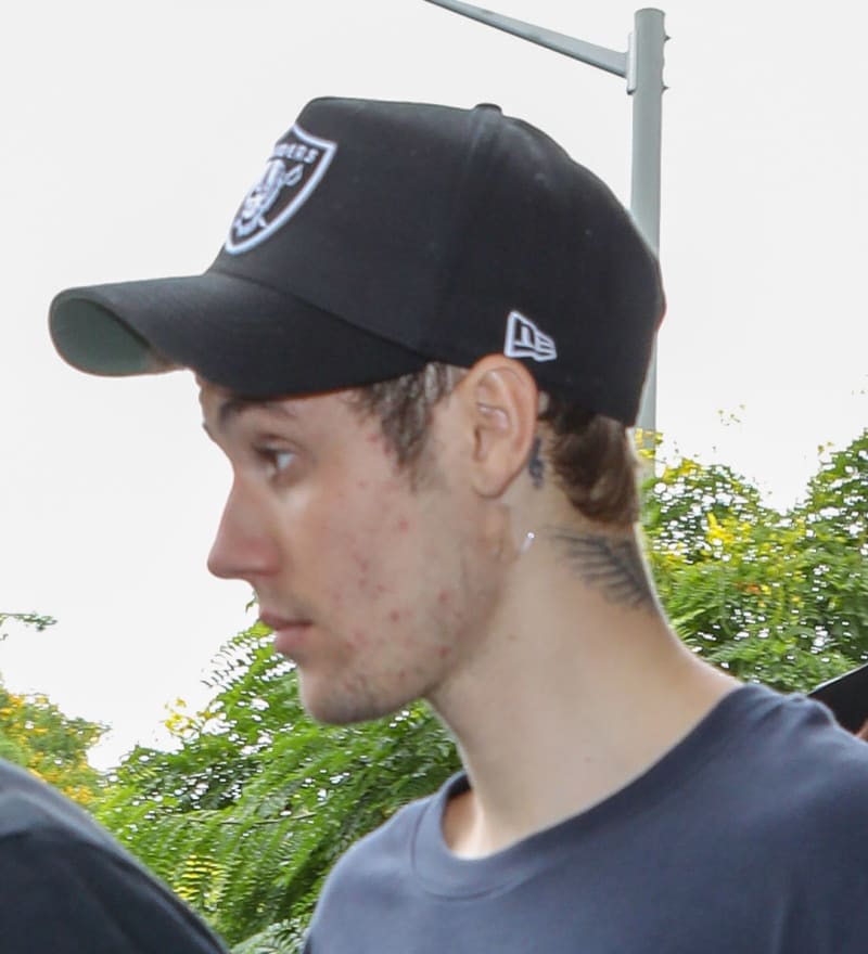 Justin Bieber bojuje s lymskou boreliózou.