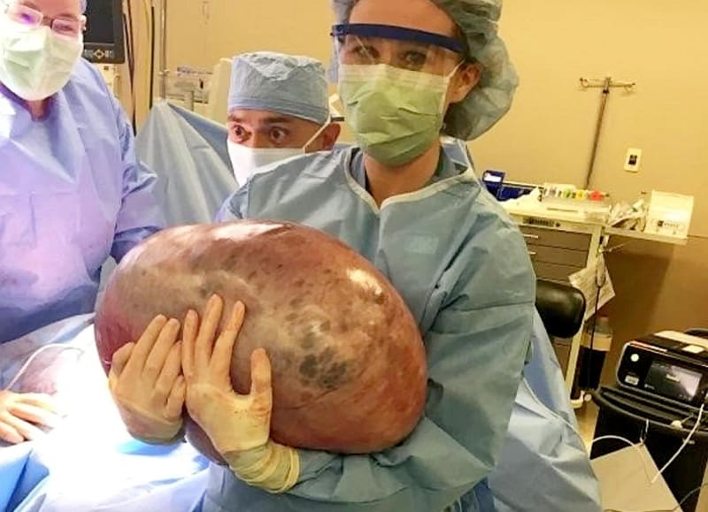 Lékaři vyoperovali ženě obří cystu z vaječníků 6