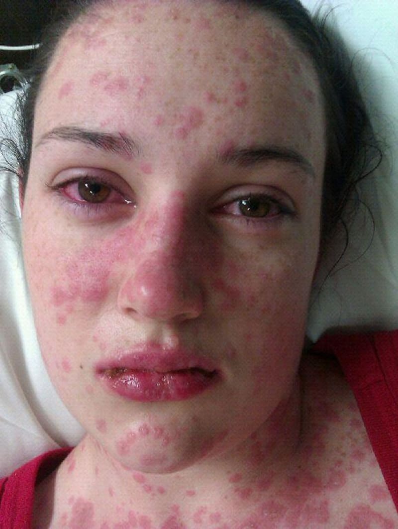 Dívka bojuje o život poté, co utrpěla strašlivou reakci na léky - Obrázek 5