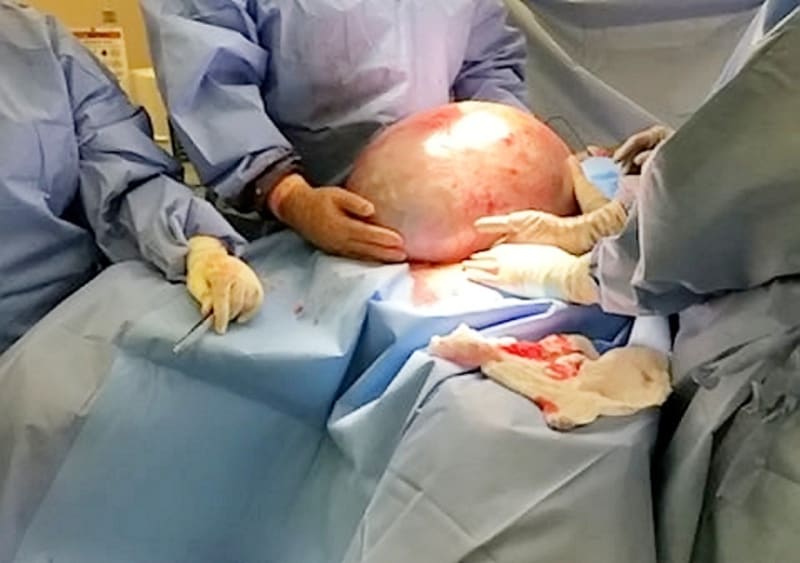 Lékaři vyoperovali ženě obří cystu z vaječníků 7