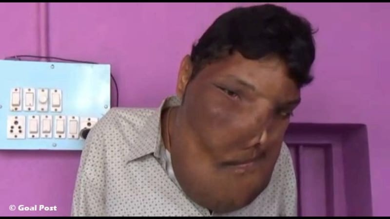 Muž žije s obřím nádorem na obličeji 2
