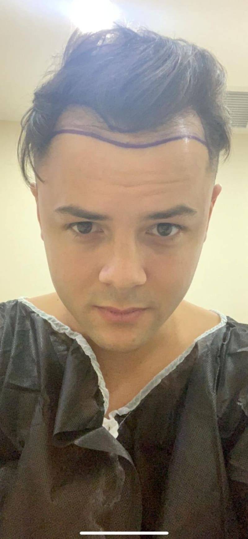 Muž byl vyděšený kvůli transplantaci vlasů, kterou podstoupil  3