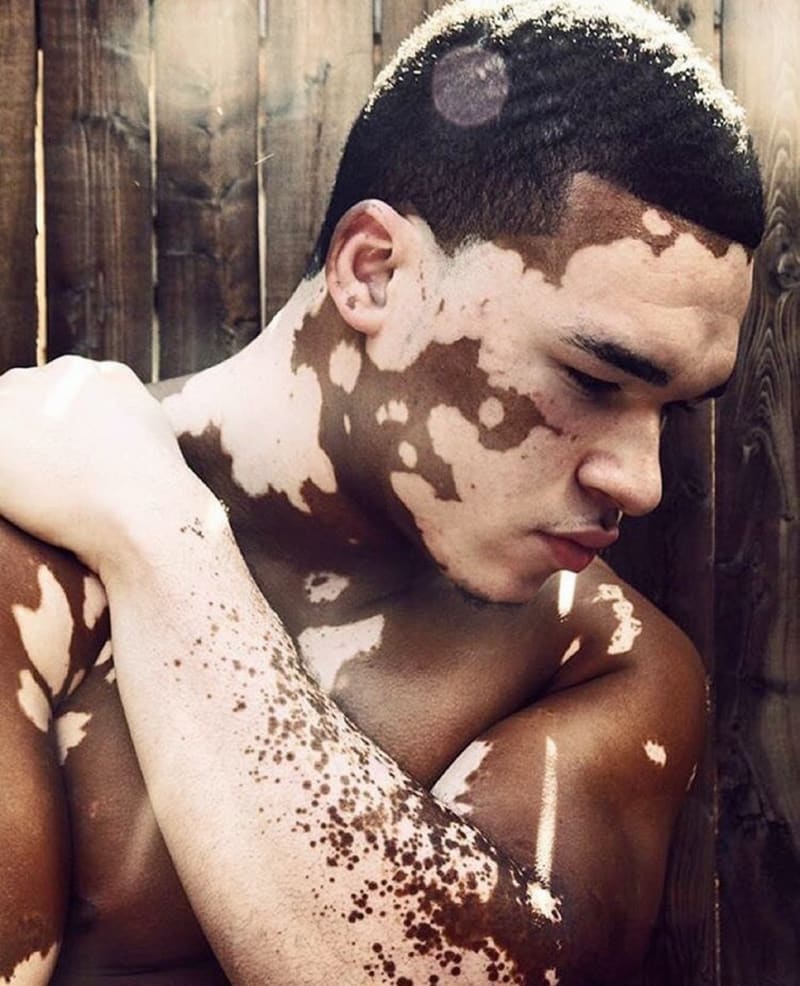 Kvůli nemoci se ztrácí kožní pigment a vznikají bílé skvrny. Na fotce Curtis McDaniel.