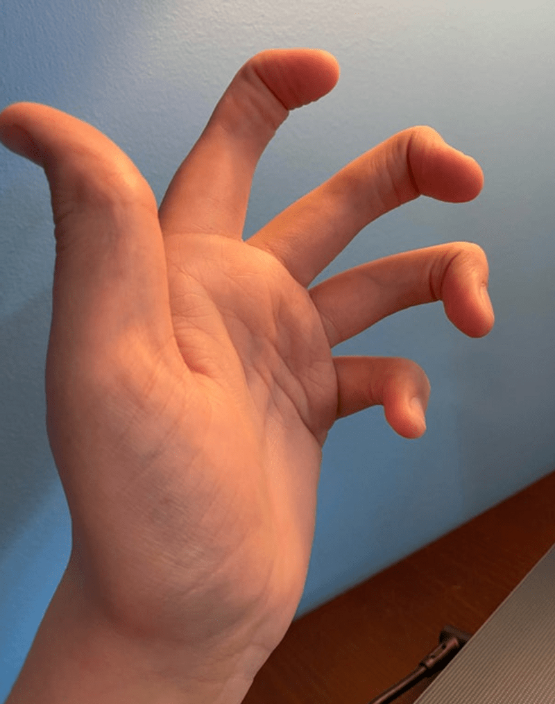 Všech pět prstů postrádá prostřední kloub