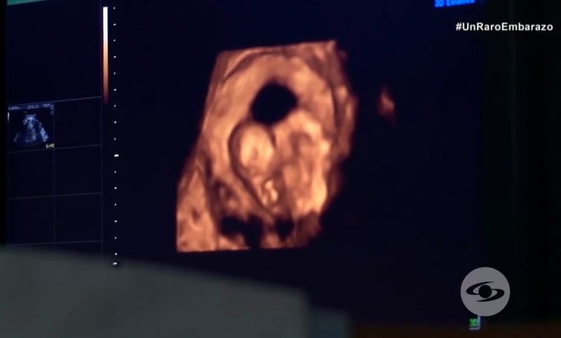 Dítě se narodilo s dvojčetem v žaludku 2